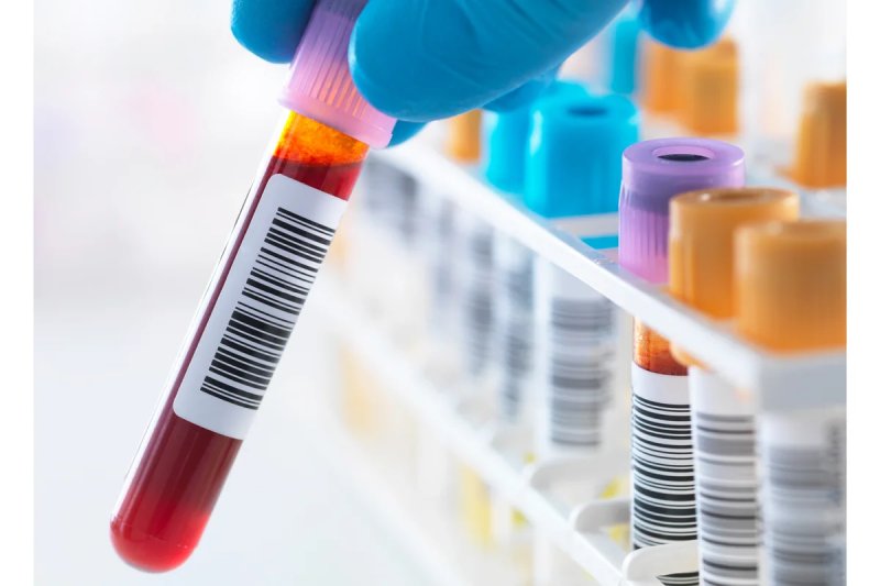Research on an Alzheimer's Disease Blood Test Is Expanding