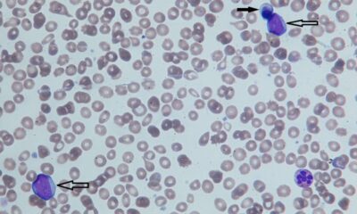 Study Discovers Benefits of Myelofibrosis Treatment Are Not Associated With Changes in Bone Marrow