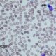 Study Discovers Benefits of Myelofibrosis Treatment Are Not Associated With Changes in Bone Marrow