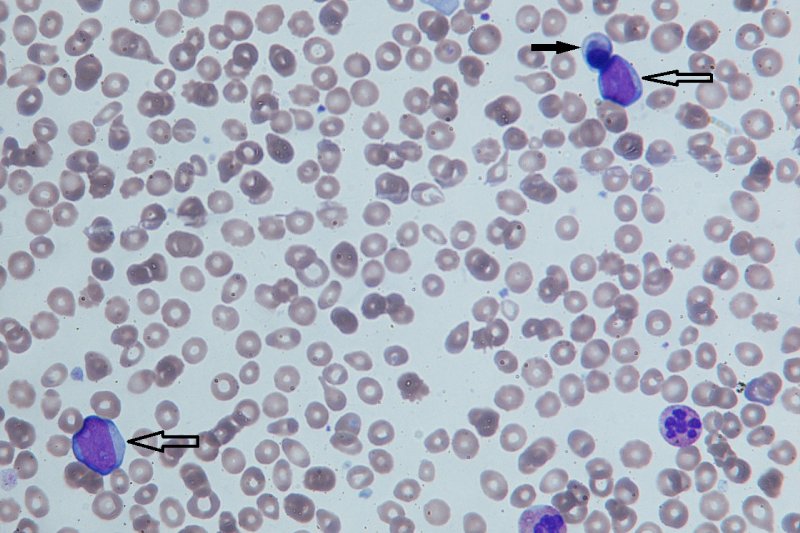 Study Discovers Benefits of Myelofibrosis Treatment Are Not Associated With Changes in Bone Marrow